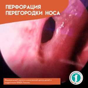 Носовые кровотечения, сухость в носу, образование большого количества «корок», появление свистящего звука при форсированном носовом дыхании могут быть признаками перфорации перегородки носа. Причин возникновения перфораций перегородки носа много, это травмы и ятрогении, системные и инфекционные заболевания и др. Нередко причиной перфорации может стать, так называемый “nasal picking” ( ковыряние в носу ). Пациенту на фото выполнены пластическое закрытие перфорации перегородки носа с использованием кровоснабжаемого мукоперихондриального лоскута и септопластика. Операция выполнена хирургической бригадой отделения патологии головы и шеи.