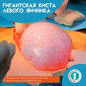 В ФНКЦ детей и подростков ФМБА России оперирована девочка 15 лет с гигантской кистой левого яичника
