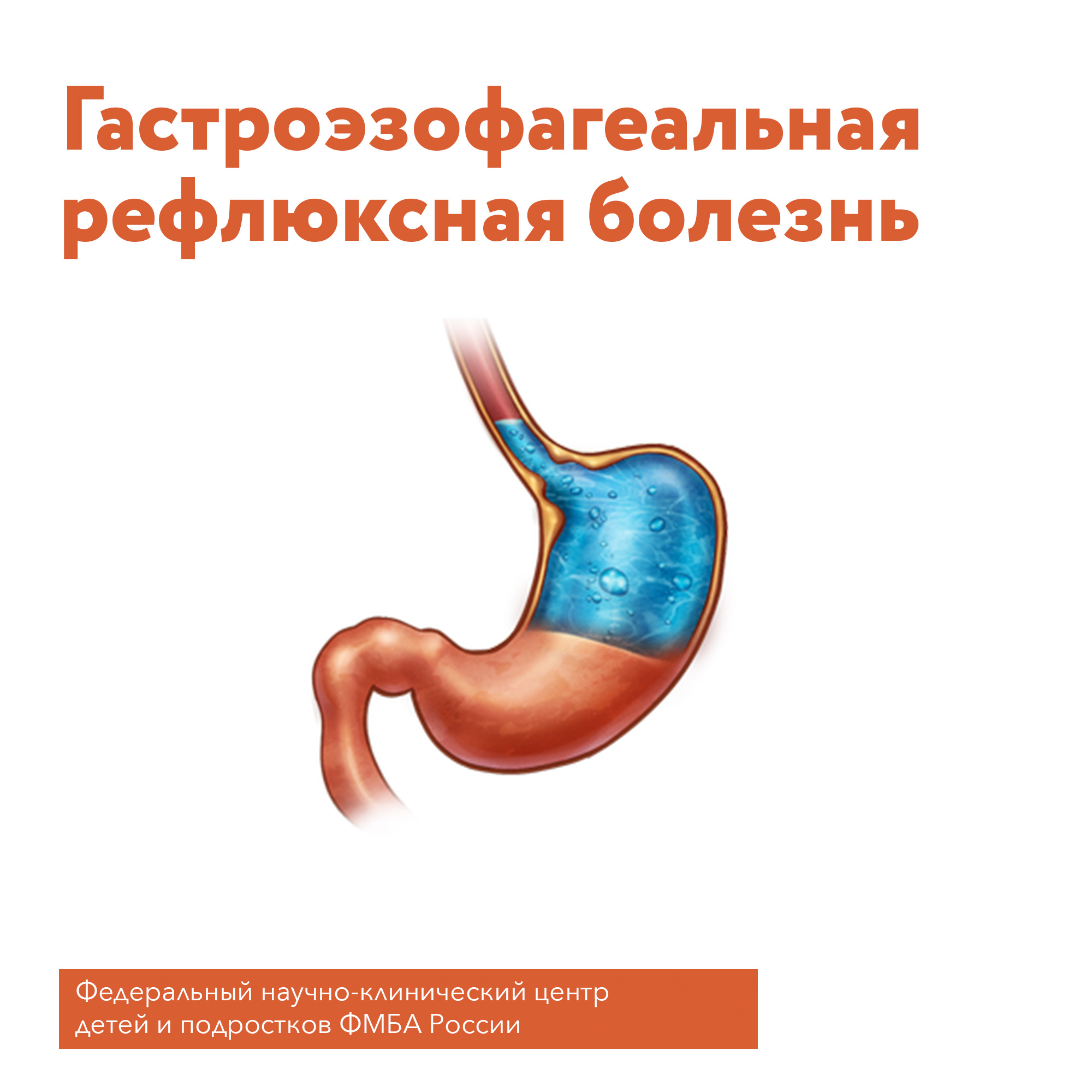 Что такое гастроэзофагеальная рефлюксная болезнь (ГЭРБ)? - Официальный сайт  ФНКЦ детей и подростков ФМБА России